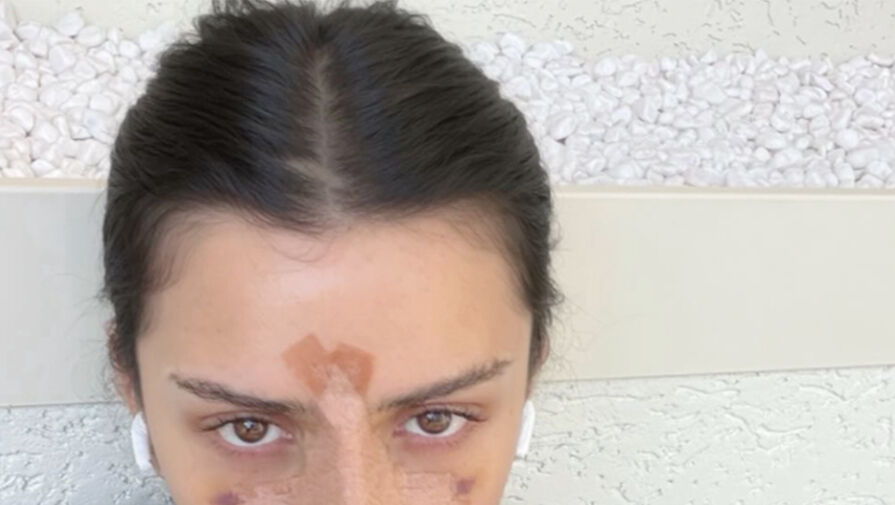 Блогерша Дина Саева опубликовала фото после ринопластики