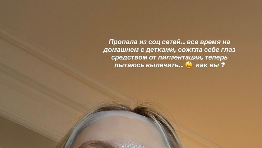 Модель Елена Перминова заявила, что сожгла глаз средством от пигментации