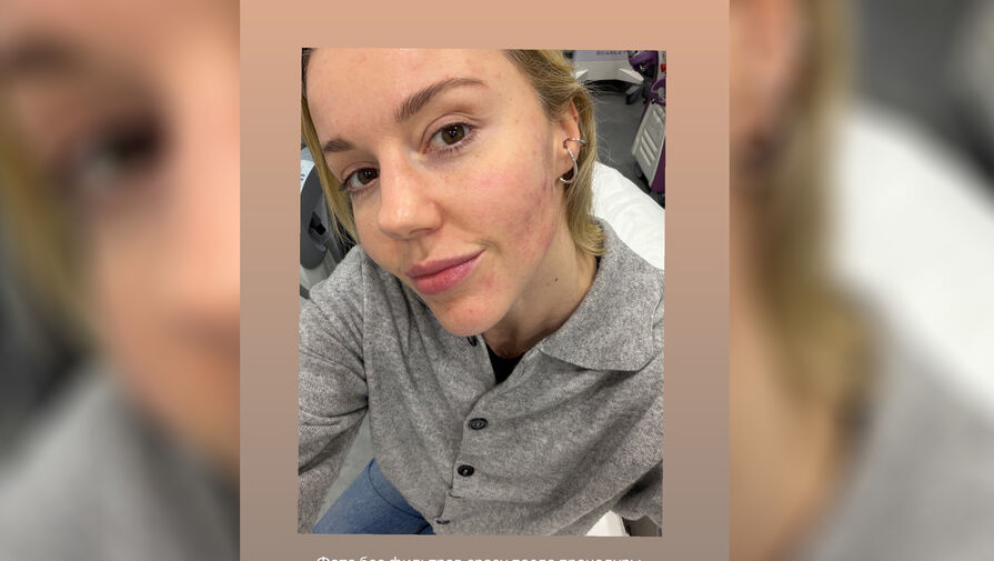 Ведущая Юлианна Караулова опубликовала фото без макияжа после уколов