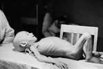 Ребенок-дистрофик во время блокады города в годы Великой Отечественной войны. Октябрь 1942 года