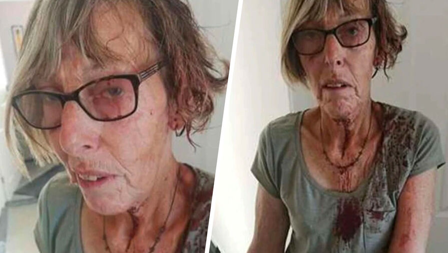 Я напоминала жертву Фредди Крюгера: чайка искусала британку до дыр в коже