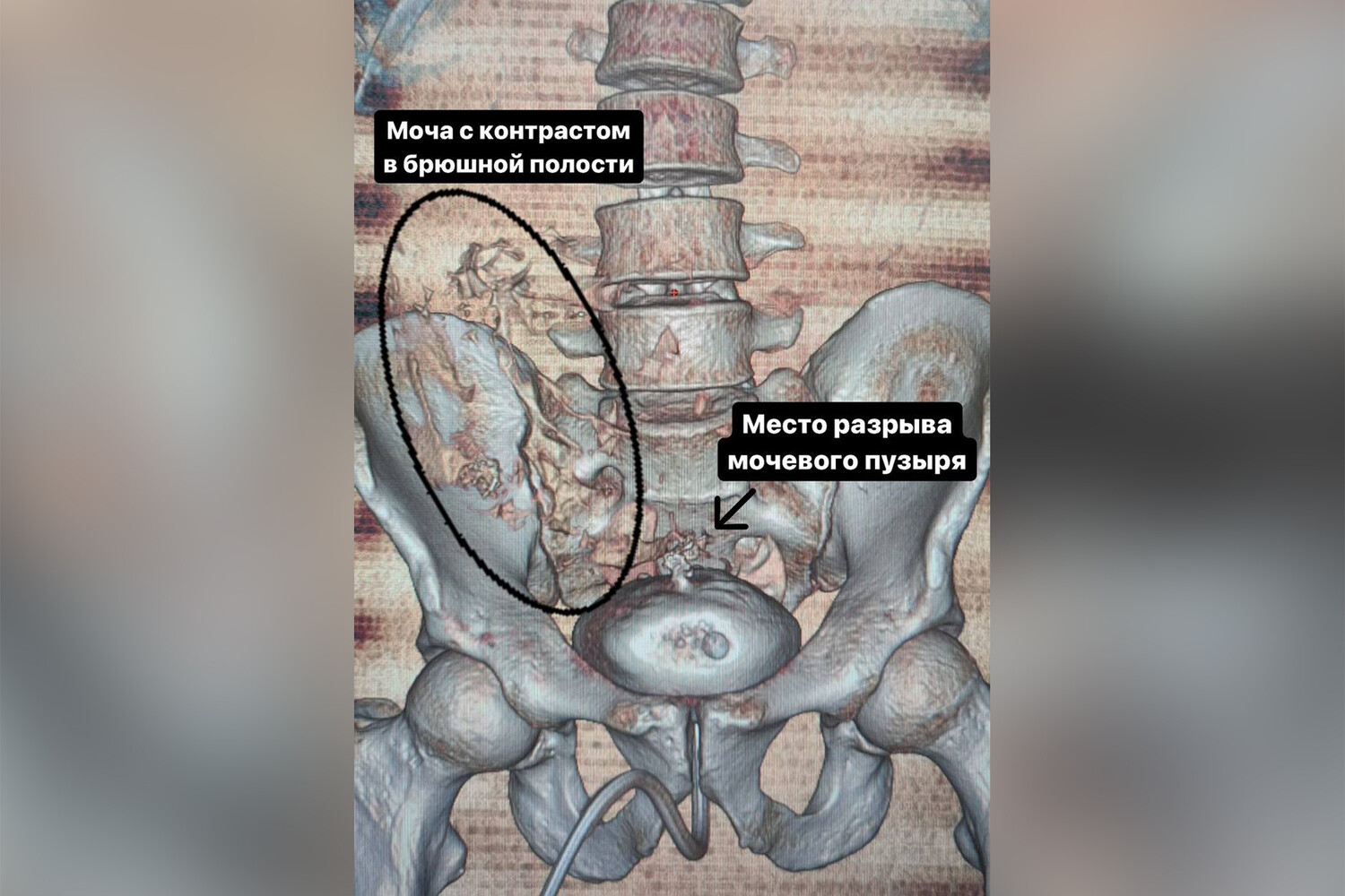 Травмы органов мочеполовой системы