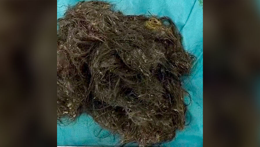 Девочка из Китая выдернула и съела 3 килограмма собственных волос, практически облысев