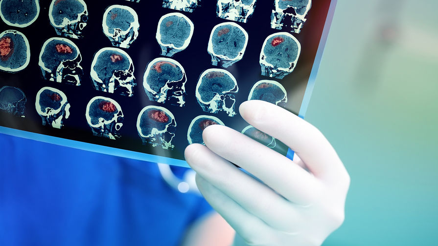 Невролог заявил, что врачи виноваты в инсультах россиян