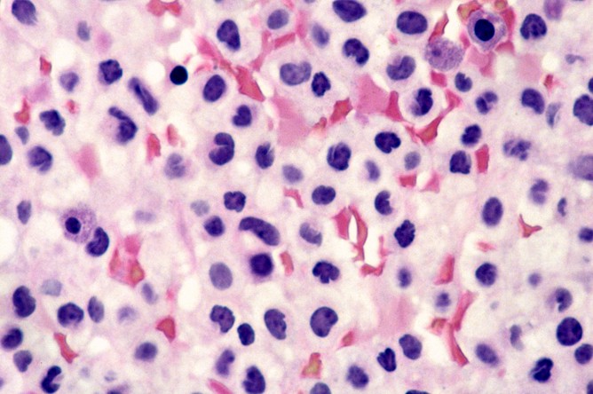 При лимфобластном лейкозе лимфоциты останавливаются в своем развитии на стадии предшественников зрелых клеток — лимфобластов