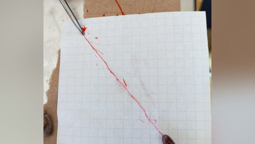 Нижегородские хирурги удалили огромного червя из мошонки подростка