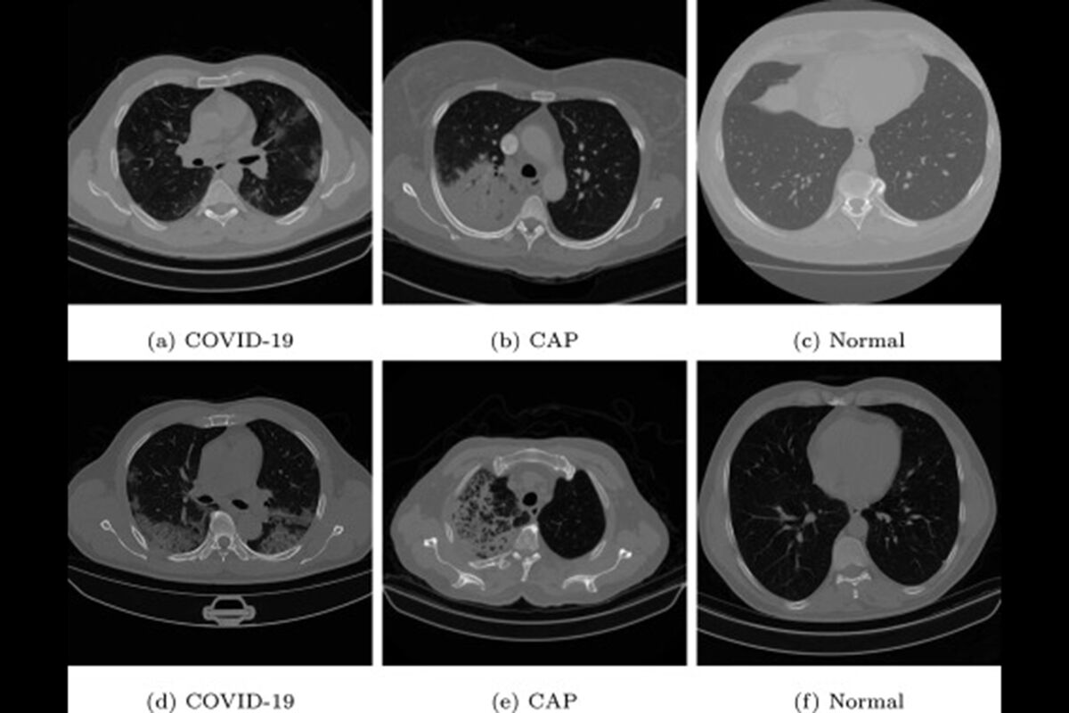 Создана самая точная нейросеть для определения COVID-19 по легким -  Газета.Ru