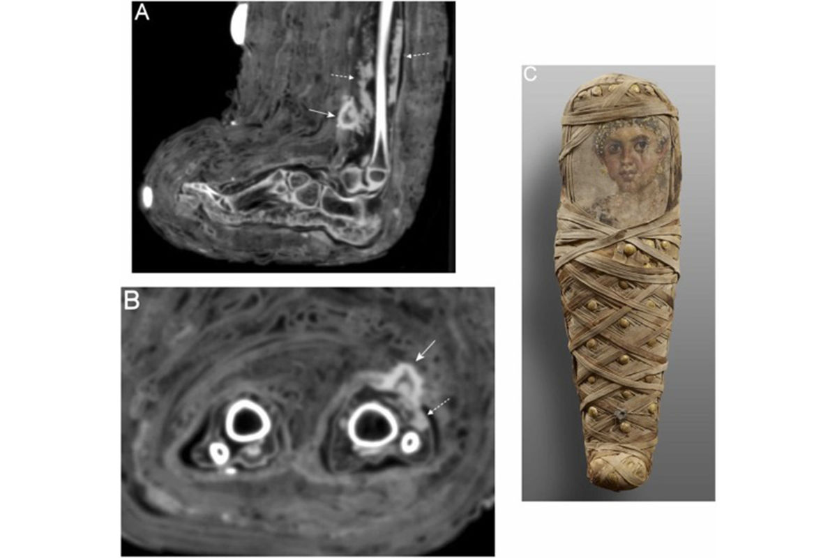 В Египте найдена мумия девочки с гнойной раной на ноге - Газета.Ru | Новости