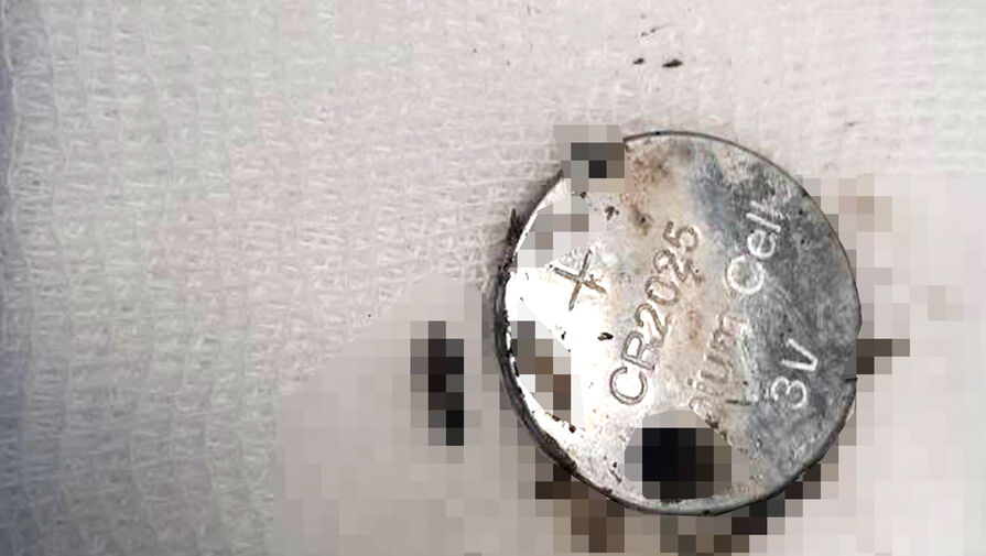 Батарейка лопнула в пищеводе у двухлетней девочки