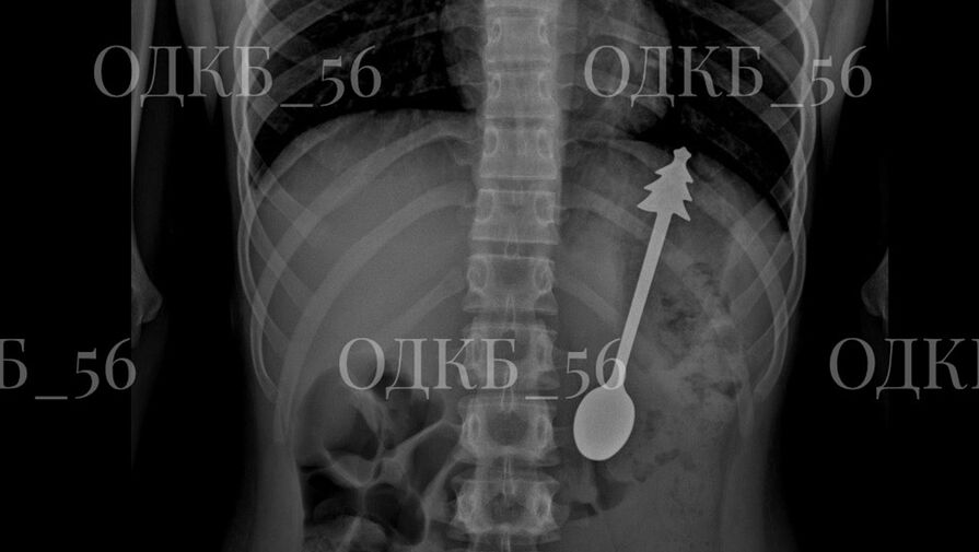 В Оренбургской области ребенок случайно проглотил 14-сантиметровую ложку
