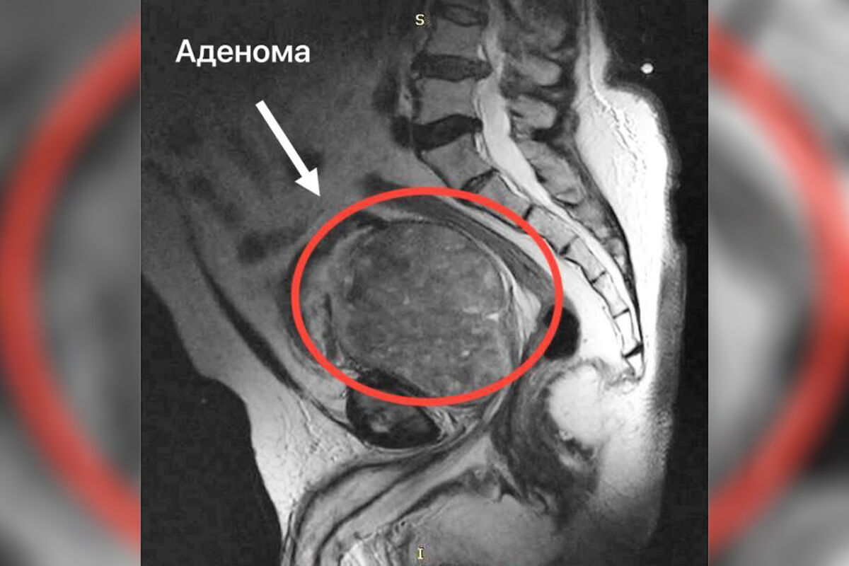 В Подмосковье врачи спасли пациента, простата которого была увеличена в 20  раз - Газета.Ru | Новости