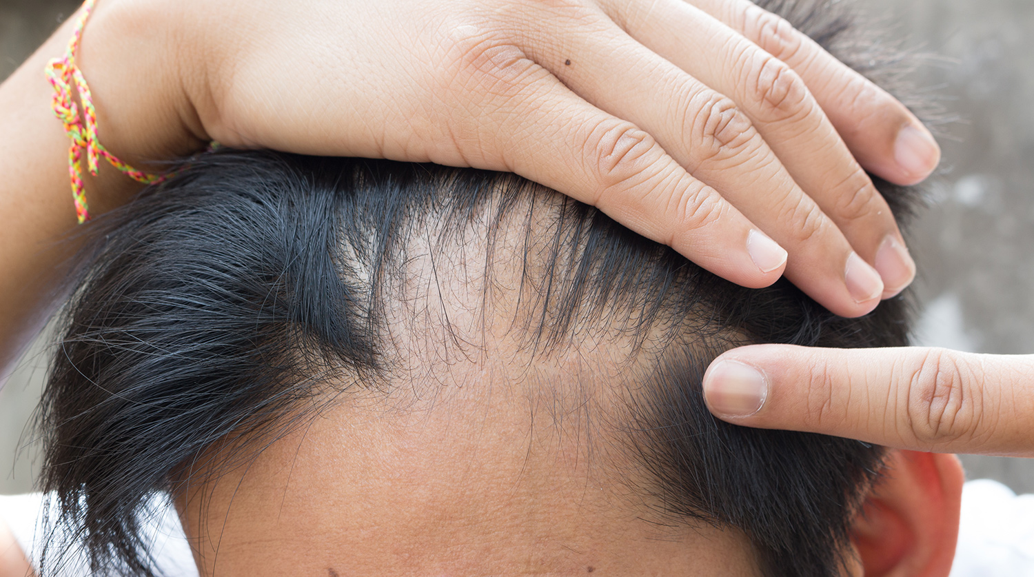Почему выпадают волосы очень сильно: причины и способы борьбы