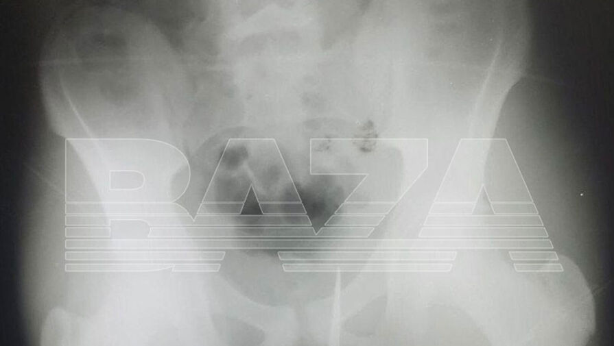 Baza: подросток из Подмосковья сел на ржавый штык винтовки