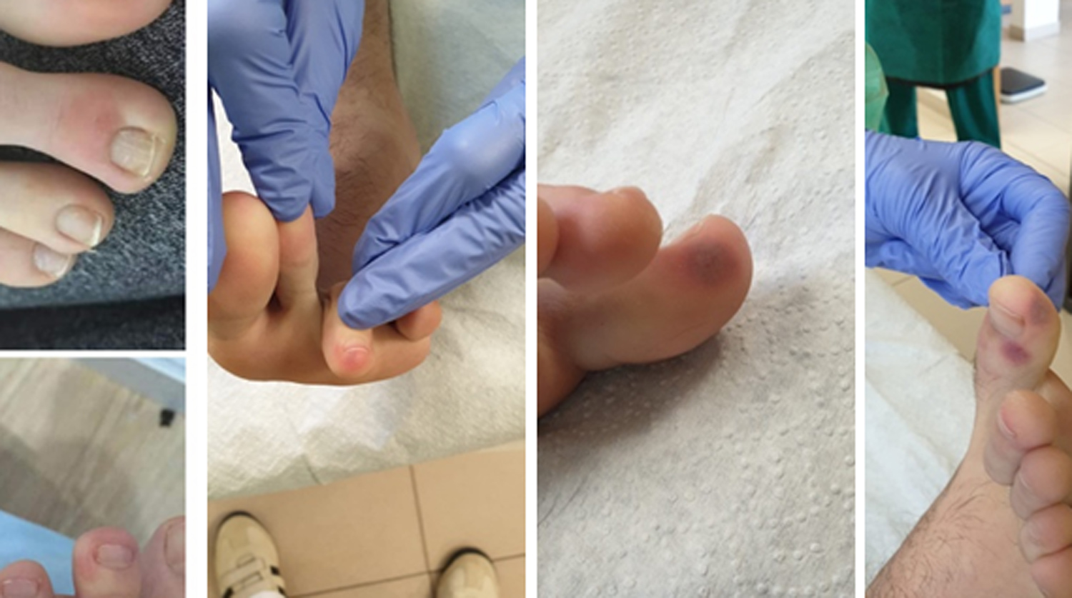 Водянистые пузырьки на пальцах ног: причины появления и методы лечения