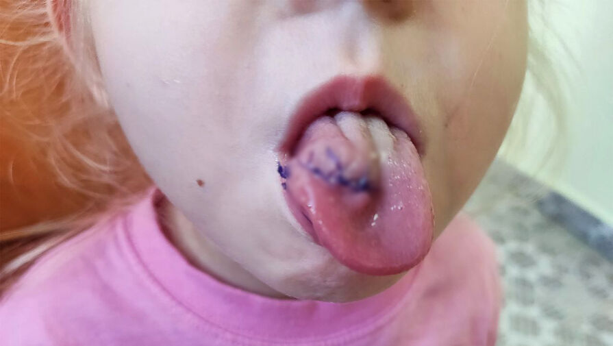 Врачи спасли ребенка с разорванным пополам языком 