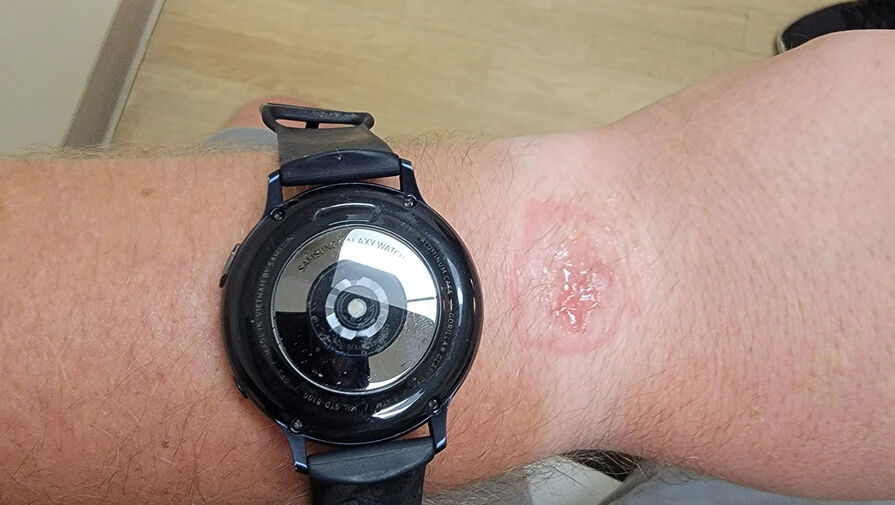 Умные часы Samsung Galaxy Watch оставили ожог на руке владельца во время сна