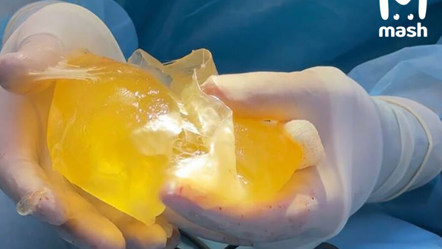 У блогерши из Уфы взорвался имплант за 200 тысяч рублей на тренировке