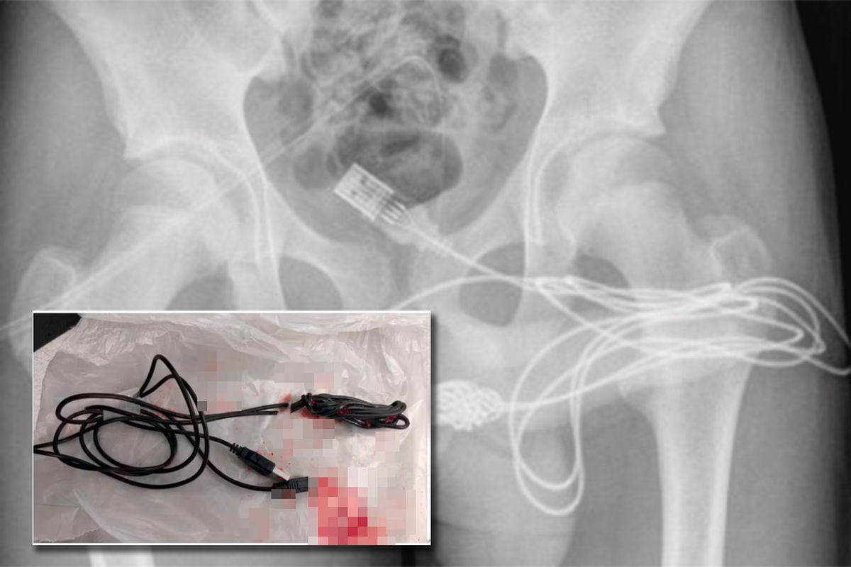 Хирурги извлекли из уретры подростка USB-кабель - Газета.Ru | Новости