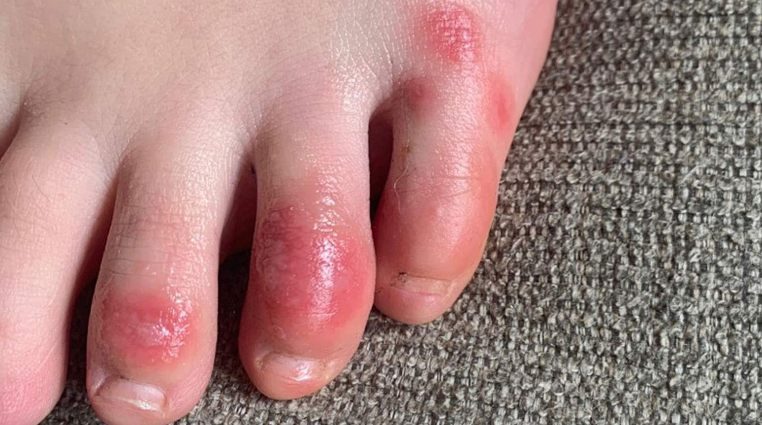 Шишки на пальцах ног - причины и симптомы