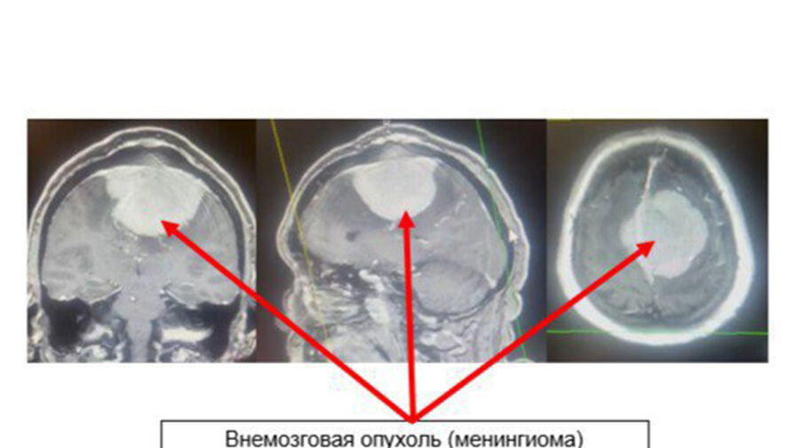 В Подмосковье у женщины с приступами эпилепсии нашли опухоль размером с бильярдный шар