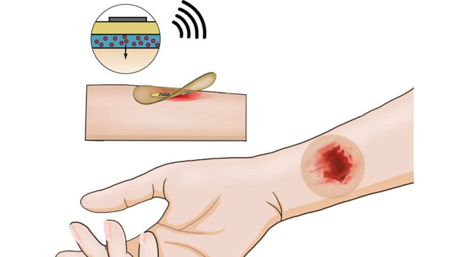 Ученые создали смарт-пластырь, который заживляет раны с помощью ударов тока