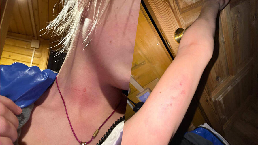 Рудковская показала следы от побоев на теле 14-летней фигуристки Костылевой