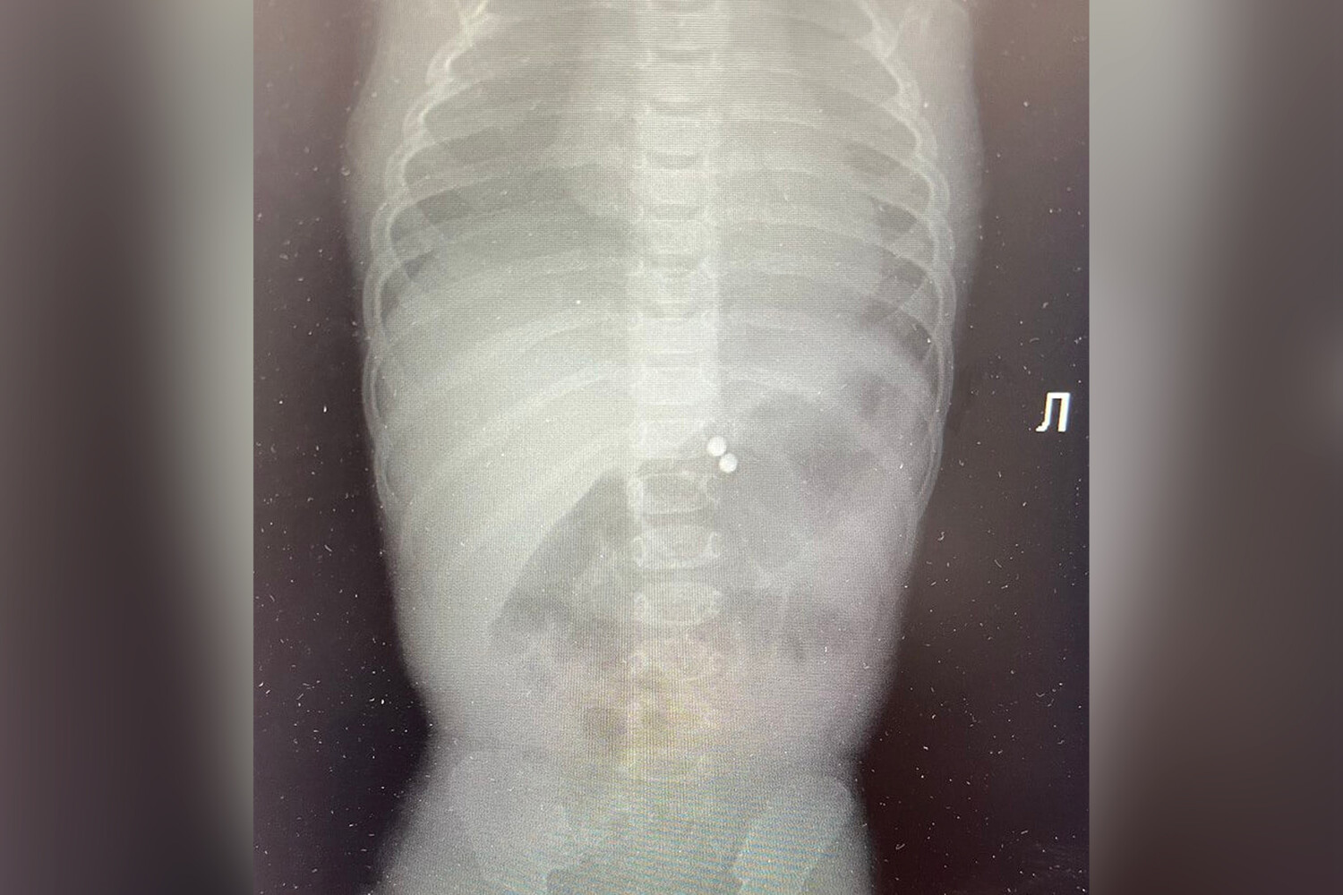 Российские врачи спасли годовалого ребенка, проглотившего магнитный  конструктор - Газета.Ru | Новости