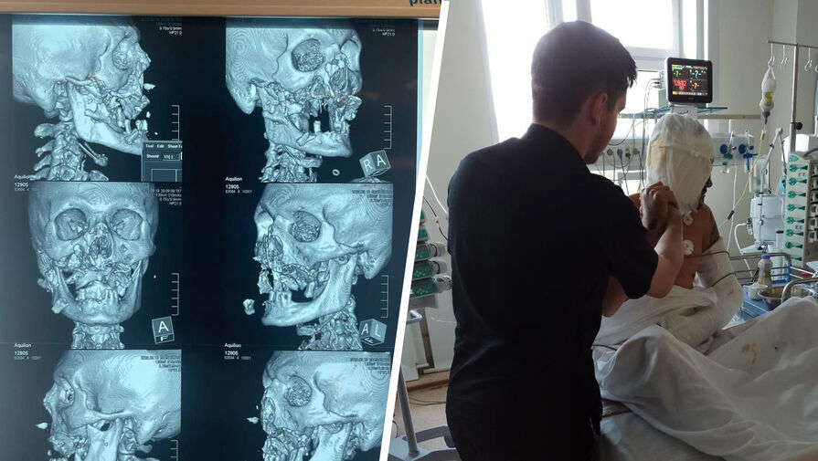 Мужчине, пережившему нападение медведя, собрали лицо по частям