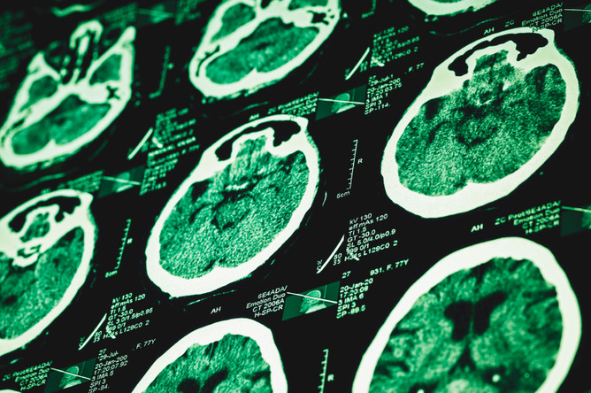 Чем больше нейролептиков принимает больной, тем больше мозговой ткани он теряет