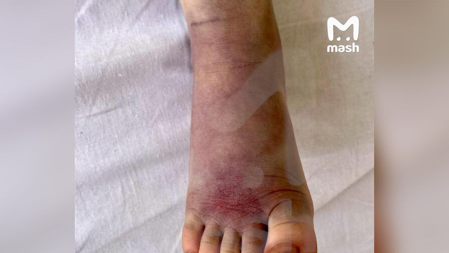 Четырехлетний мальчик попал в больницу после укуса гадюки в Подмосковье