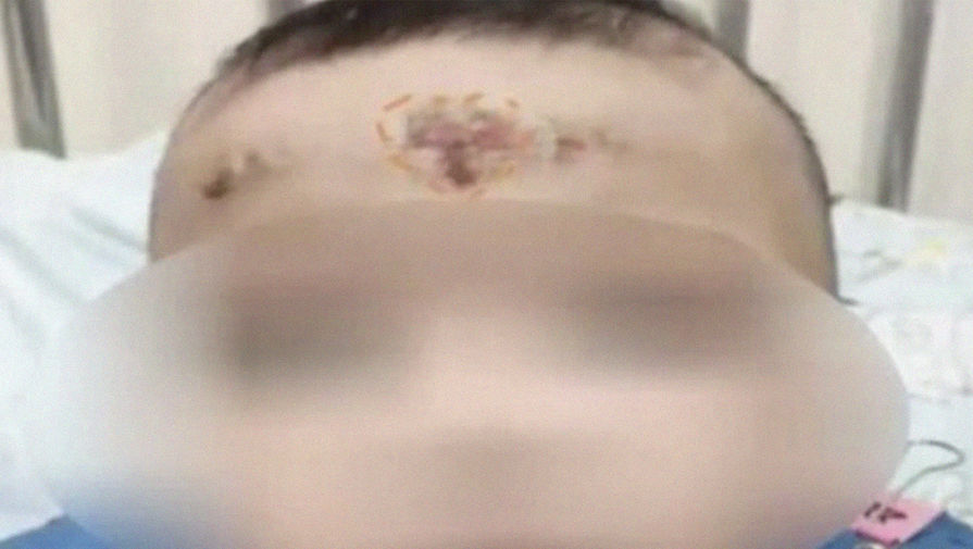 Девочка попала в больницу из-за бабушки, лечившей ее кашель с помощью монеты