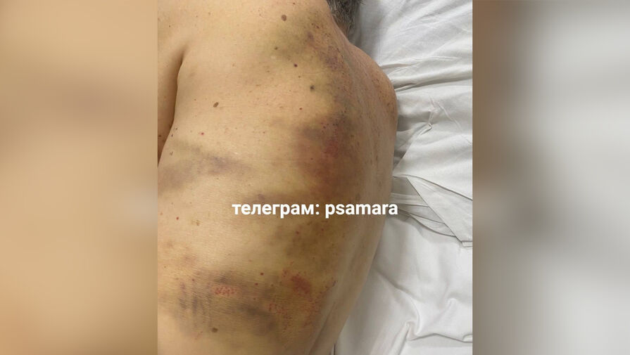 В Самаре пенсионер попал в больницу после избиения неизвестными