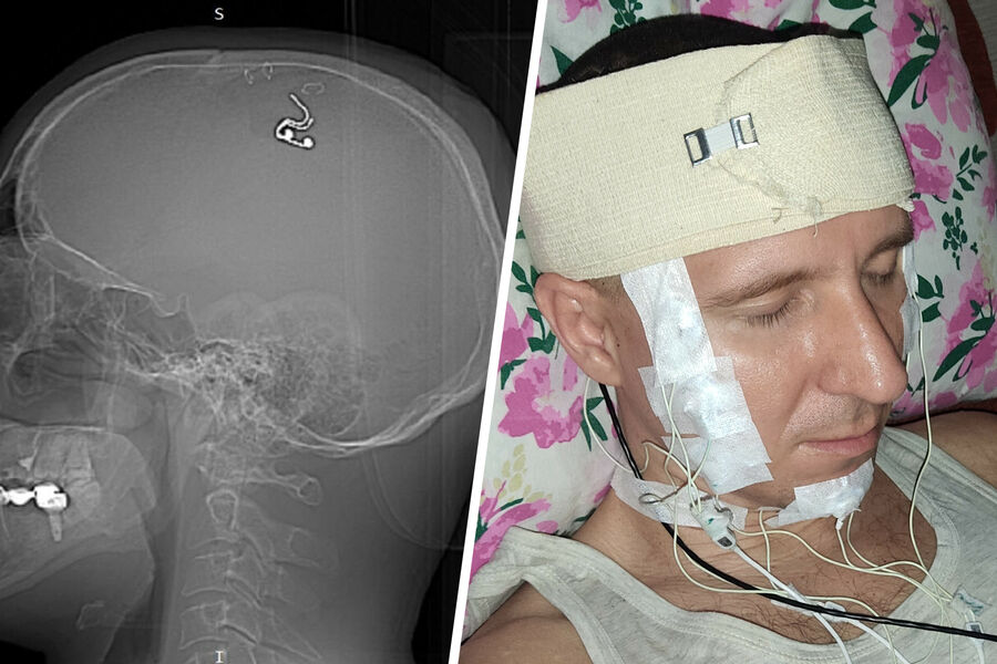 Михаил Радуга провел себе трепанацию черепа дома с помощью дрели и вживил себе в мозг имплант