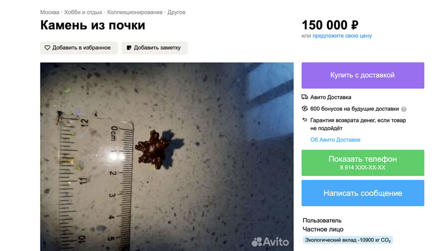 Житель Барнаула выставил на продажу чужой почечный камень за 150 тыс. рублей