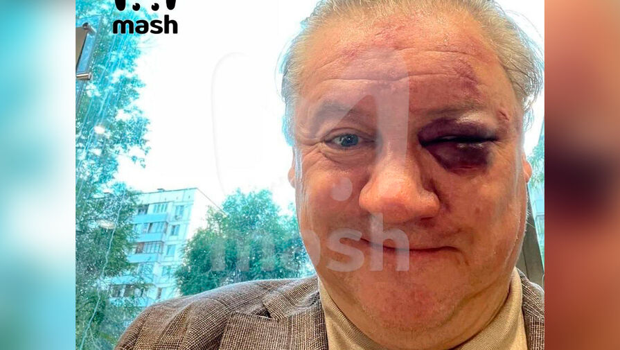 Появилось фото экс-футболиста Канчельскиса, которого избили в московском баре