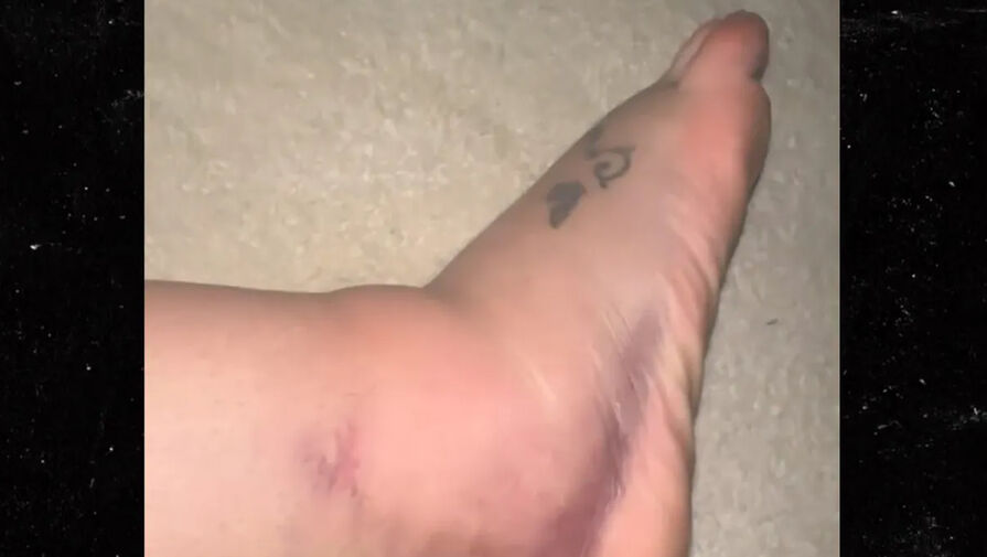 Бритни Спирс показала опухшую сломанную ногу, которую не лечит