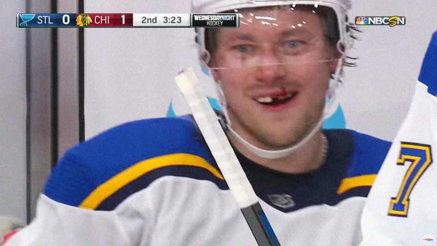 Нападающий клуба НХЛ «Сент-Луис Блюз» Владимир Тарасенко с выбитым во время матча с «Чикаго Блэкхокс» зубом, 14 ноября 2018 года. Скриншот из видео