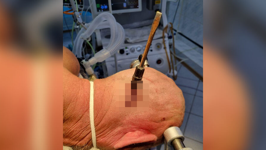 Башкирские врачи прооперировали мужчину с отверткой в голове