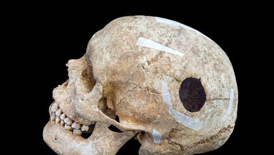 Археологи обнаружили доказательства, что трепанацию черепа проводили в IX веке