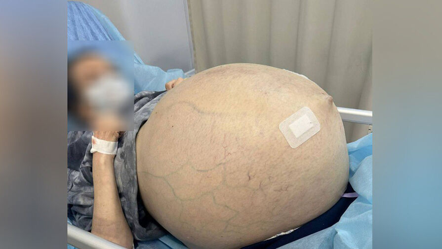 Москвичке удалили гигантскую опухоль яичника весом 30 килограммов