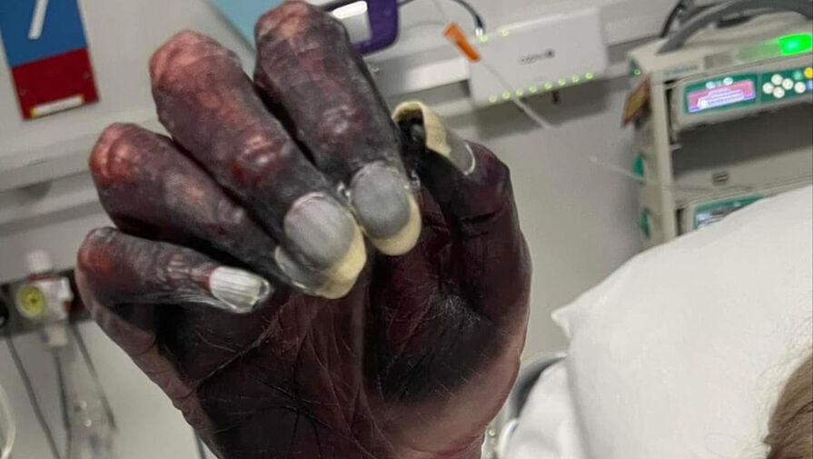 Женщине ампутировали руку после того, как врачи приняли некроз за чернила газеты