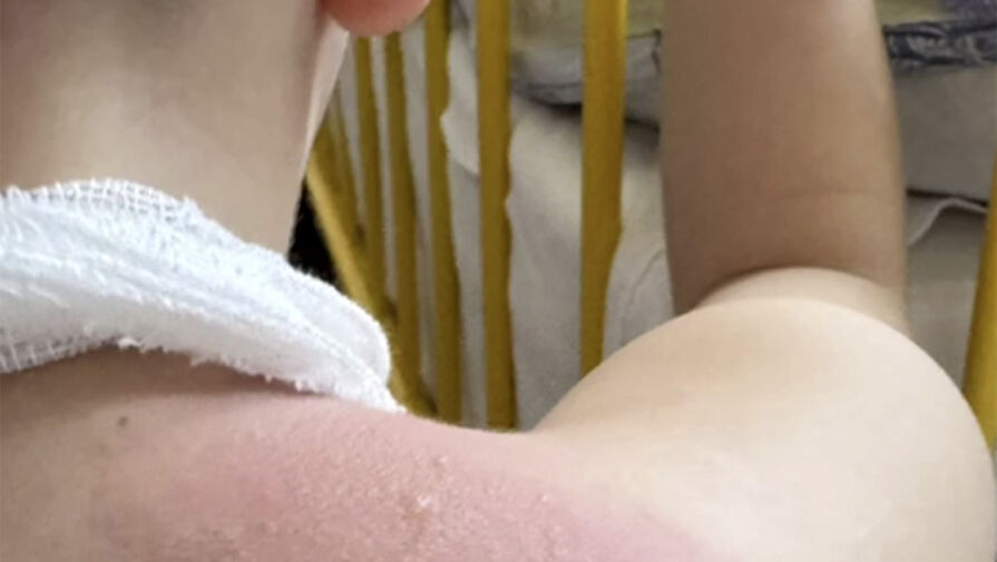 Поход в севастопольский бассейн обернулся ожогами для пятилетнего посетителя