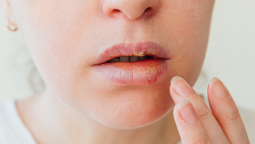 Стало известно, что частое появление герпеса на губах может быть связано с деменцией