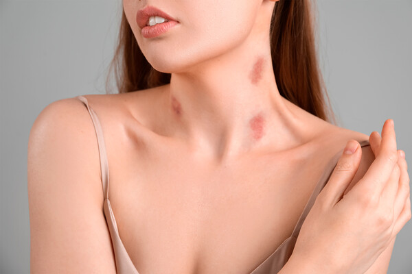 Как убрать засосы на шее очень быстро