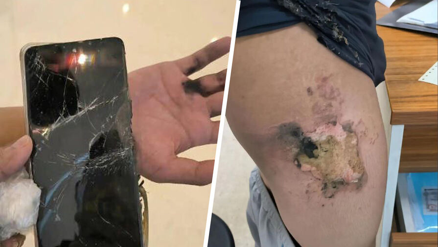 Мужчина получил серьезные ожоги при взрыве смартфона Redmi Note 11T Pro