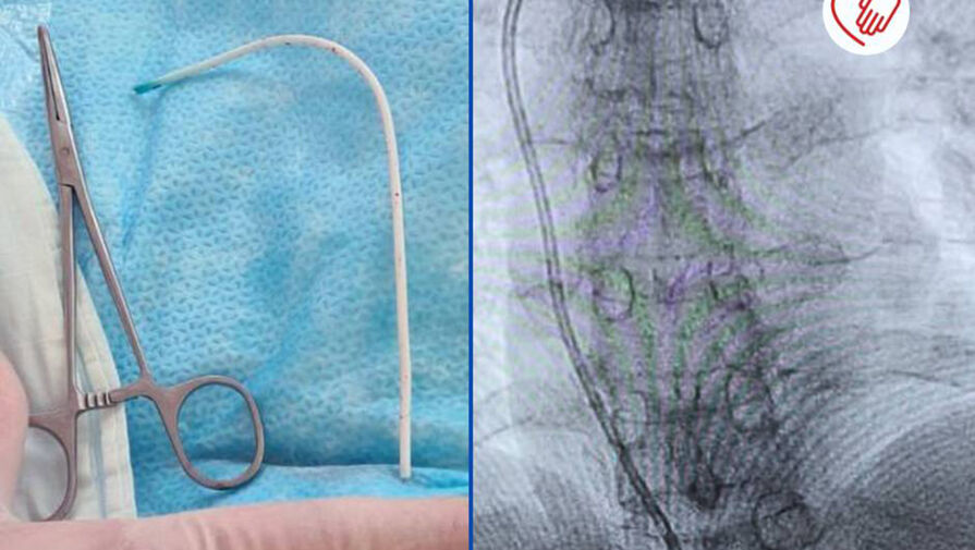 В Нижневартовске хирурги спасли пациентку с застрявшим в сердце катетером 