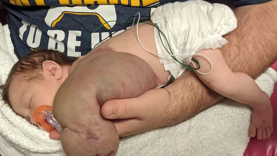 Врачи спасли новорожденную девочку с кистой на руке размером с ананас