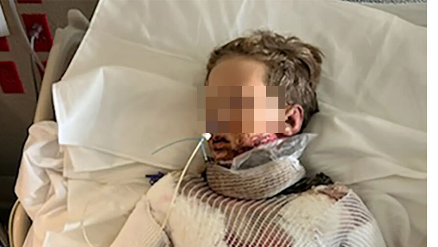 12-летний мальчик попал в реанимацию после неудачного химического эксперимента