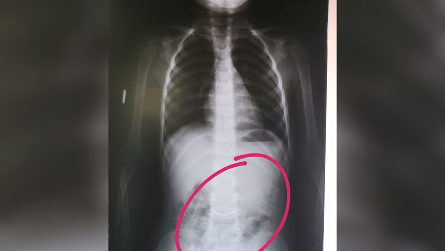 В Башкирии трехлетний мальчик целиком проглотил металлическую цепочку 