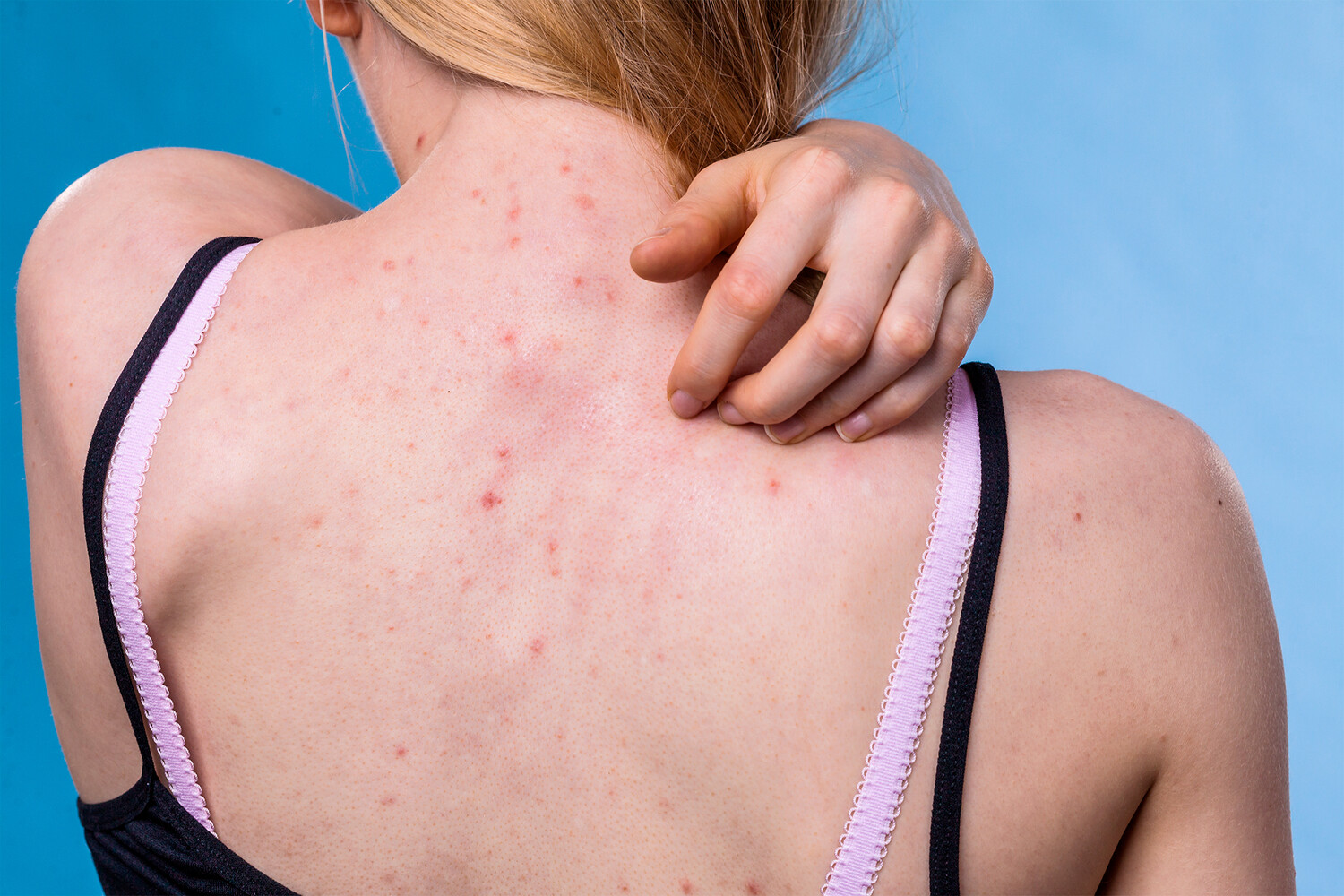 Почему появляется сыпь на коже: 5 самых распространенных причин
